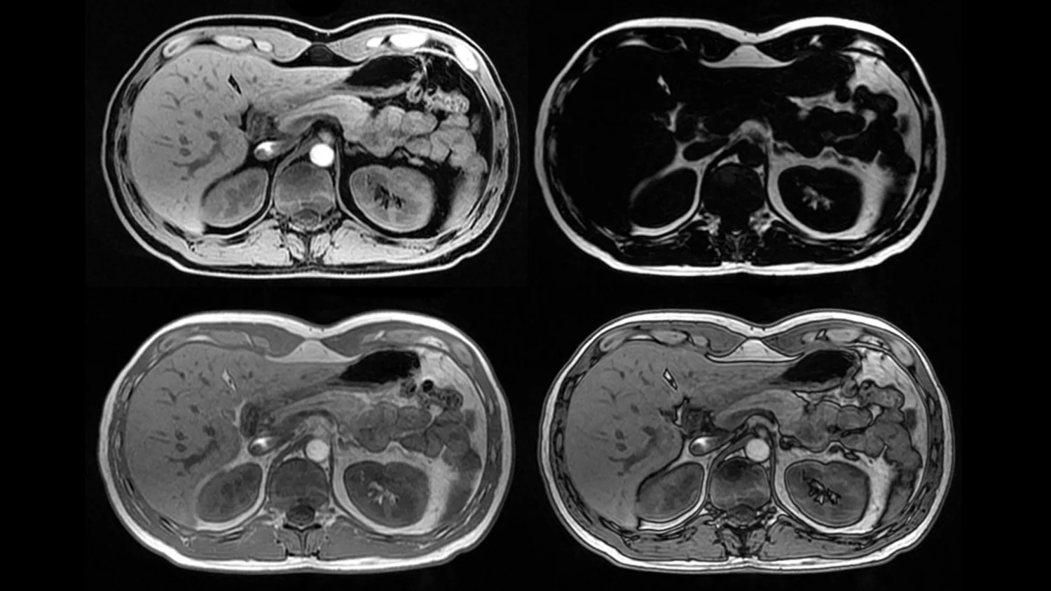 Abdominal CT