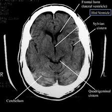 Brain CT Scan