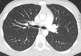 Chest CT